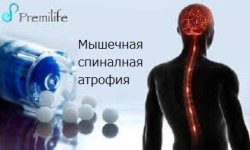 Когда нижние конечности перестают работать, или мышечная спинальная атрофия